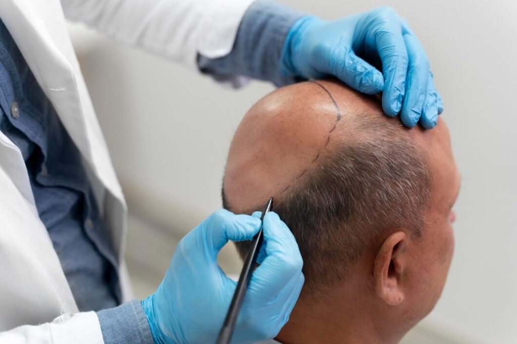 Hair Transplant Procedure